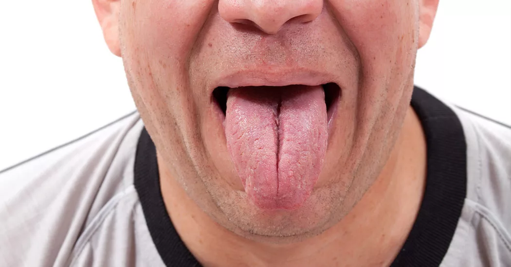 Tongue Exercises for snoring and sleep apnea
